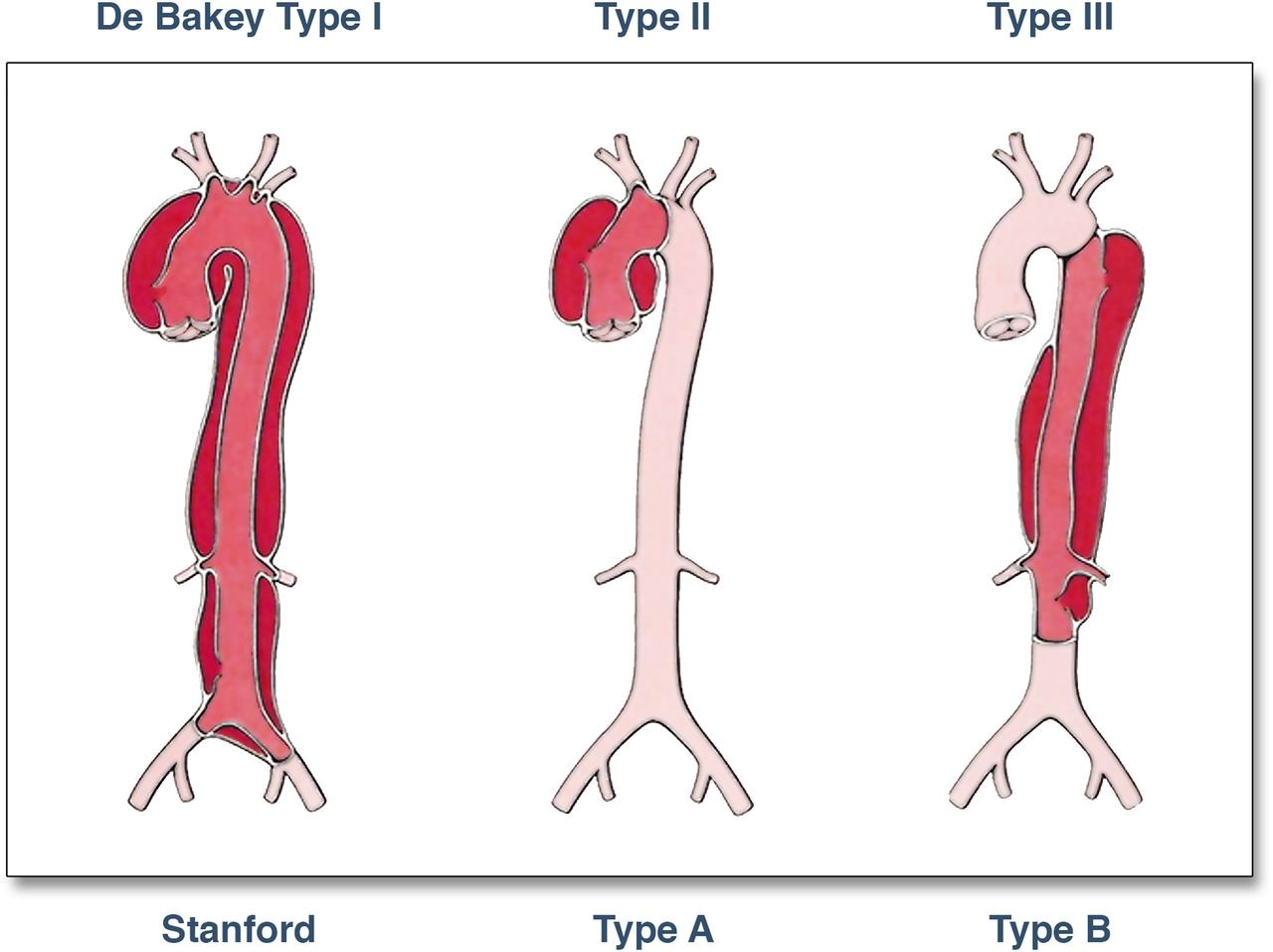 aortic dissection