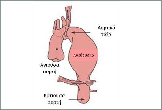 anebrisma-thorakikis-1