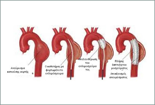 anebrisma-thorakikis-2