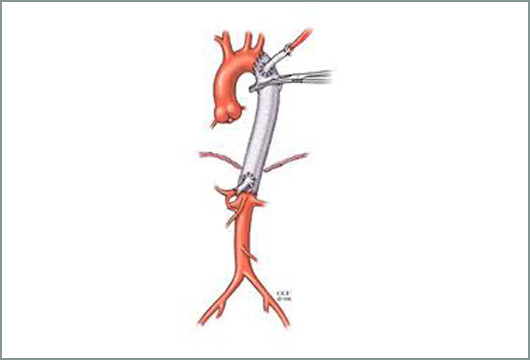 anebrisma-thorakikis-3