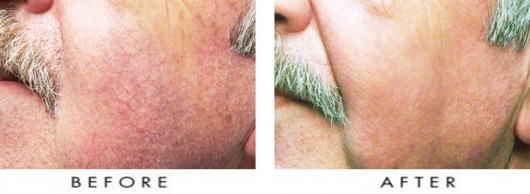 Facial-Spider-Vein-Treatment-1-530x194