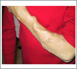 fistula-1