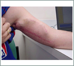 fistula-2