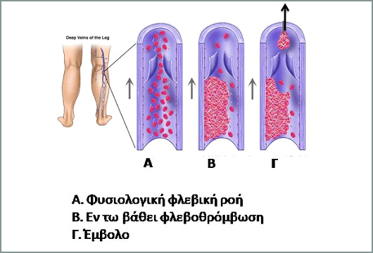 flevothromvosi1