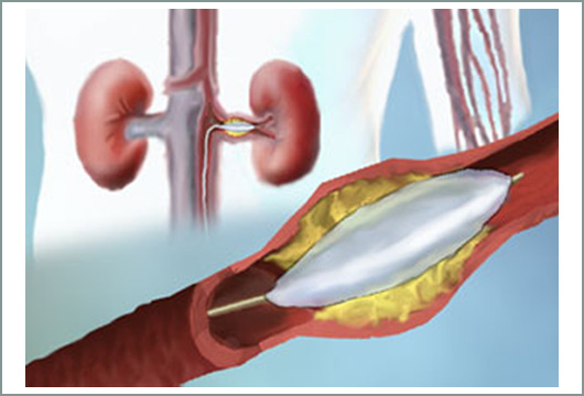 nefragiakes-pathisis