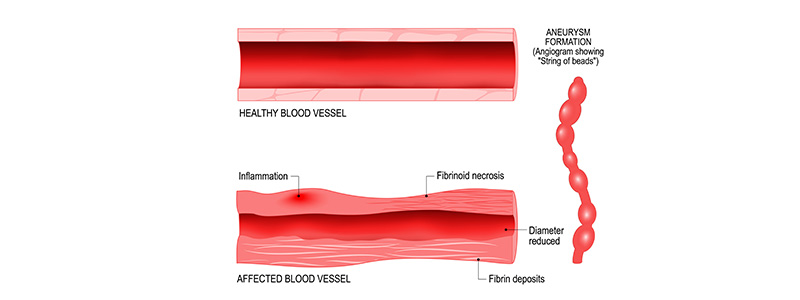 vasculitis